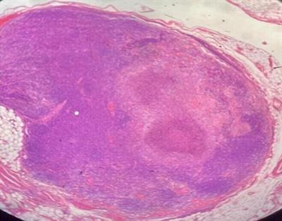 Cat scratch disease in a 23-year-old male–Case report